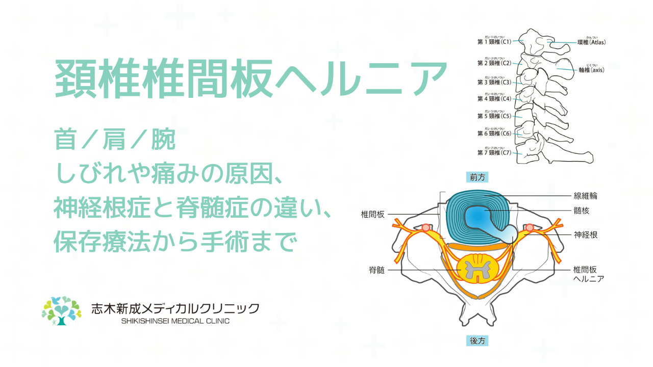 頚椎椎間板ヘルニアの原因、首・肩・腕の痛みやしびれ症状は治る?