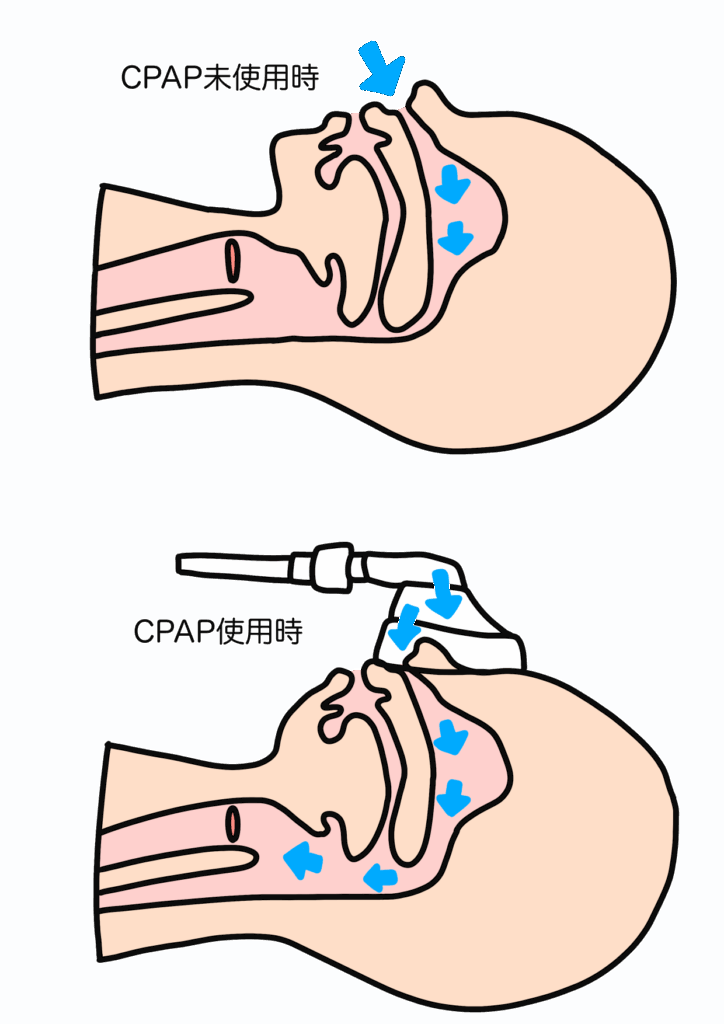 CPAP(シーパップ)療法