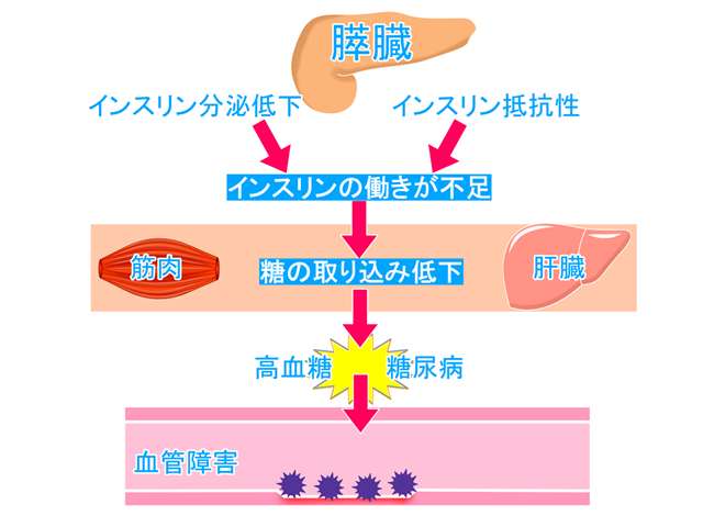 糖尿病とは、血液中のブドウ糖（血糖）が慢性的に高くなる病気
