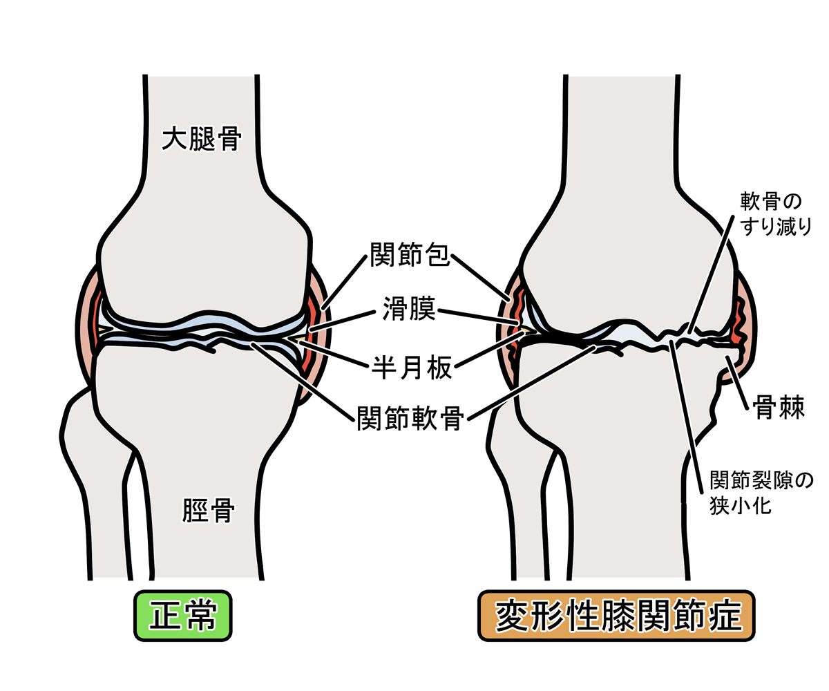 変形性膝関節症の症状とは?原因、治し方、してはいけないこと