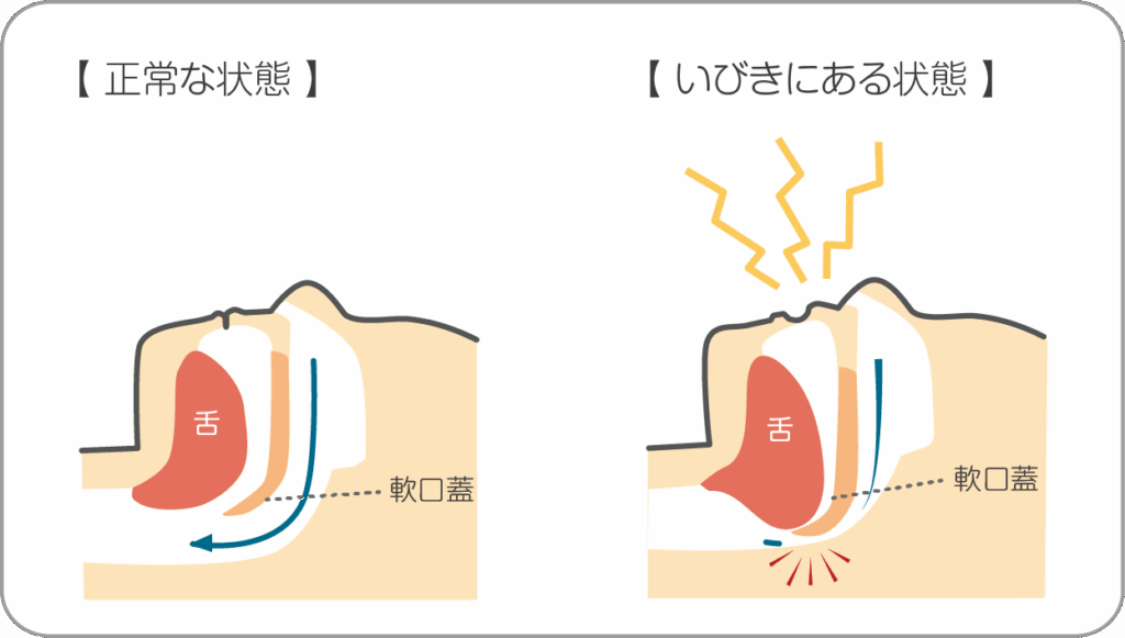 舌根沈下でいびき